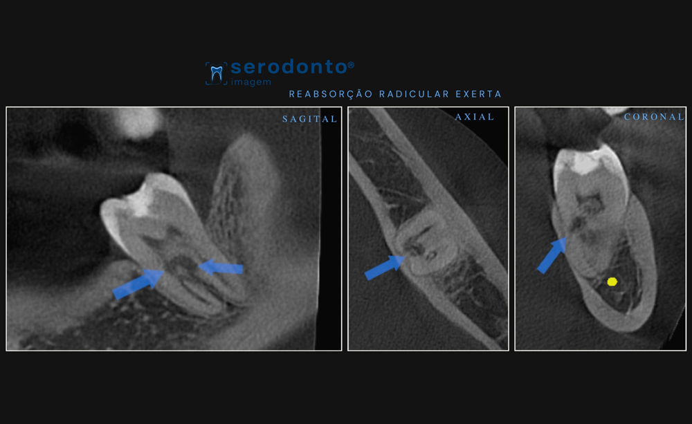 reabsorcao-radicular-externa-avaliando-a-extensao-com-tomografia