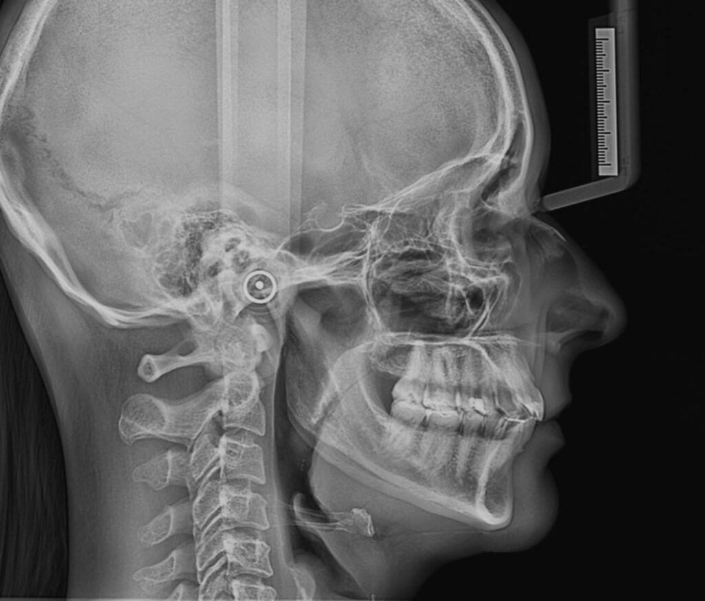 Telerradiografia Lateral: Avaliação Ortodôntica e Planejamento Cirúrgico